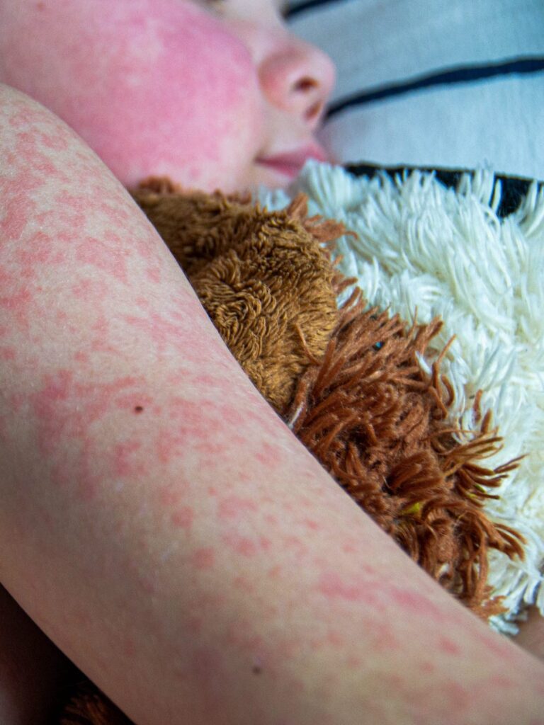 Canada loses measles elimination status; Lambton reports 20 cases total