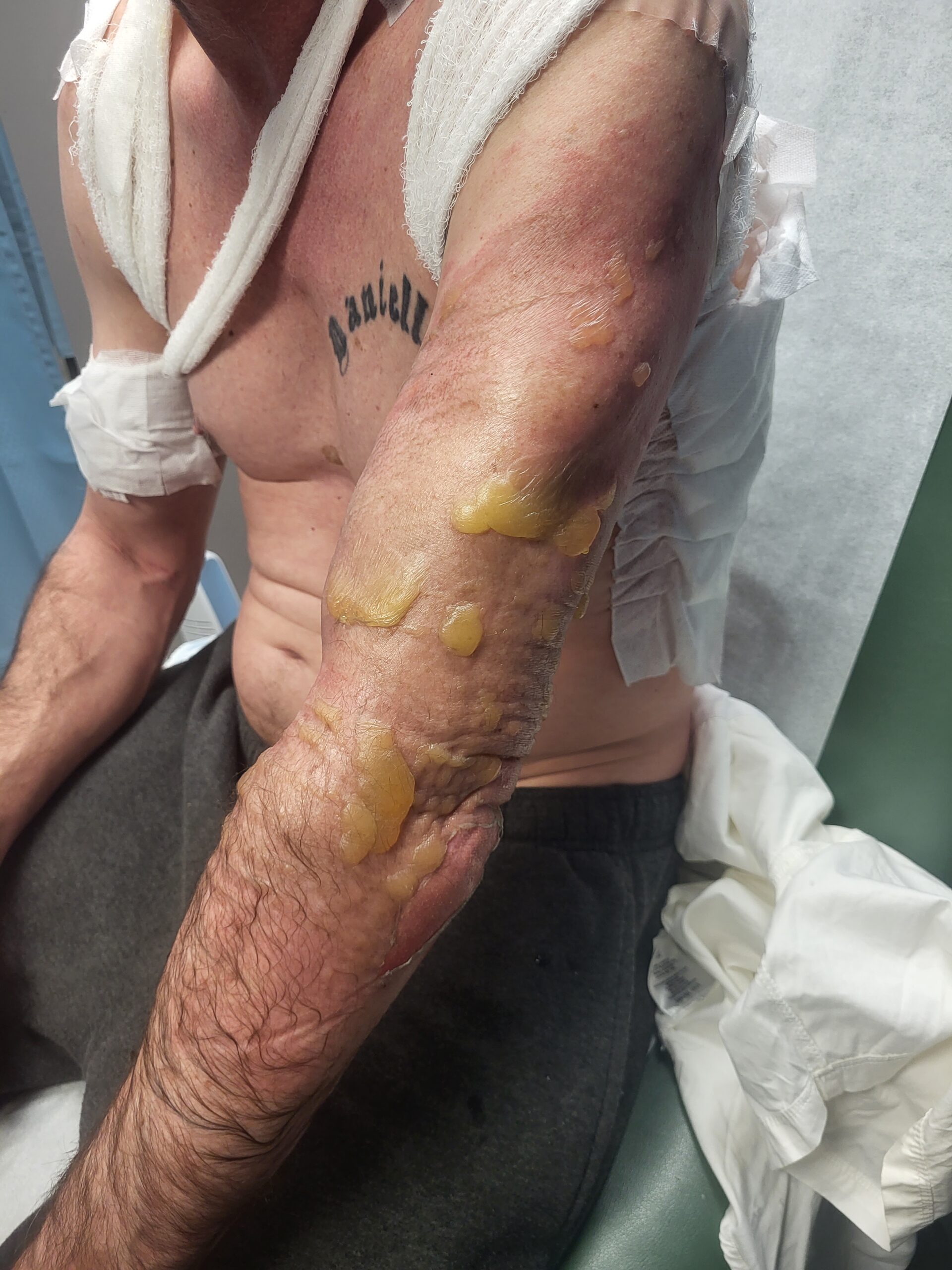 “I thought I was going to die”: Sarnia worker describes life-altering injuries after steam blast at NOVA Chemicals